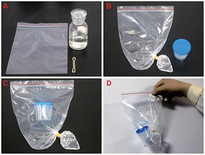 A New Method for the Sputum Cytology Test Without Direct Contact to Specimens During COVID-19 Pandemic